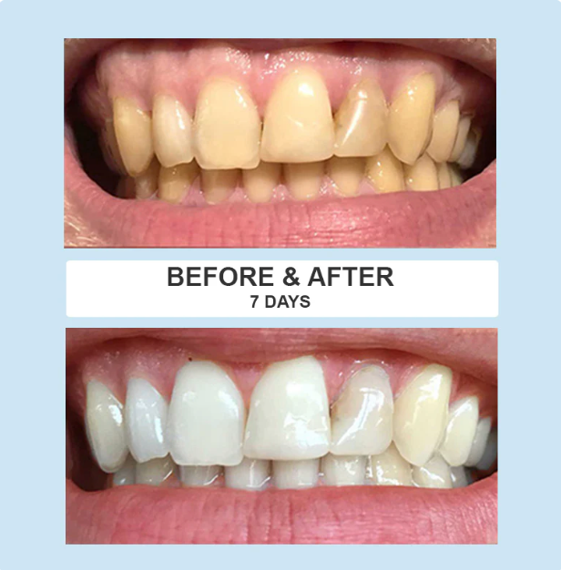 LumiSmile Teeth Whitening Kit