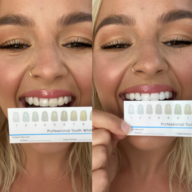 LumiSmile Teeth Whitening Kit